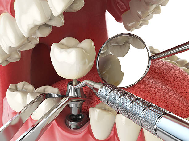 Best Emergency Tooth Extraction in Energy, IL