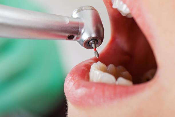 Best Emergency Tooth Extraction in Energy, IL